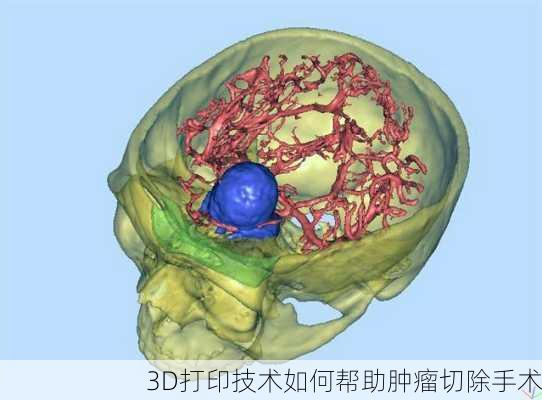 3D打印技术如何帮助肿瘤切除手术