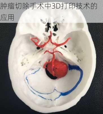 肿瘤切除手术中3D打印技术的应用