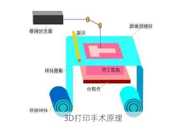 3D打印手术原理