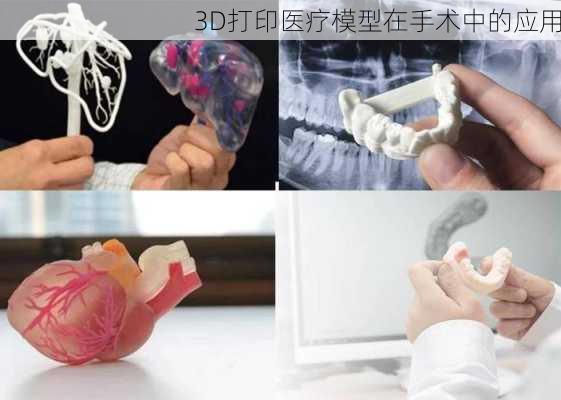 3D打印医疗模型在手术中的应用