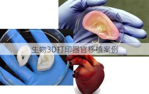 生物3D打印器官移植案例